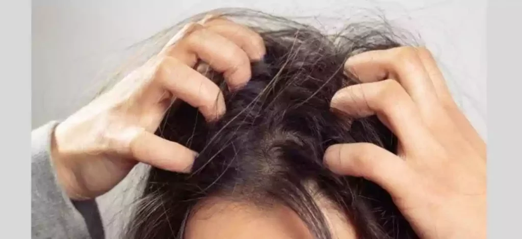 Home Remedies For Dandruff And Itchy Scalp
